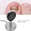 Onychomycosis Treatment Light Toenail Fingernail Care Painless Onychomycosis Remover Device