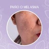 Crema Despigmentante Manchas Melasma Acné Paño