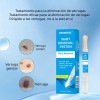 Bolígrafo Reparador De Verrugas, Seguro E Indoloro