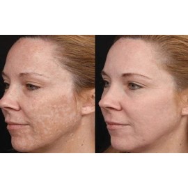 LasmaX-Skin® Anti Aging DARK SPOT CORRECTOR for Face, Body Age Spot Remover