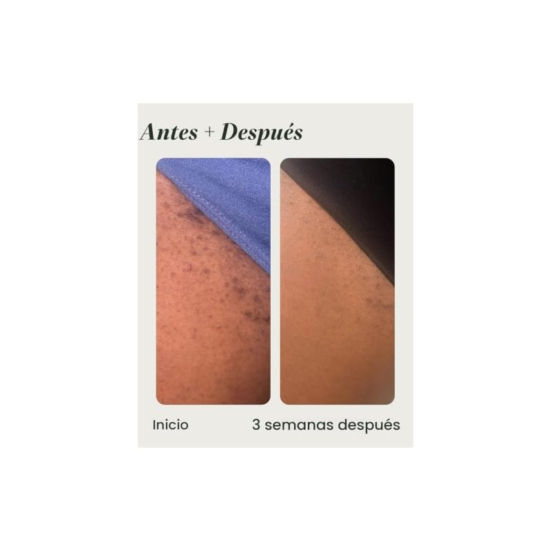 Topicals High Roller Ingrown Hair Tonic with Salicylic Acid, AHAs