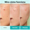 Parches Anti Acne Invisibles Espinillas Granos 108pzs