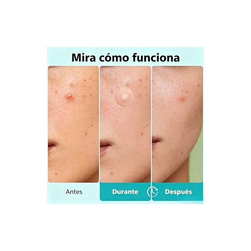 Parches Anti Acne Invisibles Espinillas Granos 108pzs