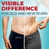 Medical Grade Silicone Scar Tape - 1.6”x120” - Visible Difference