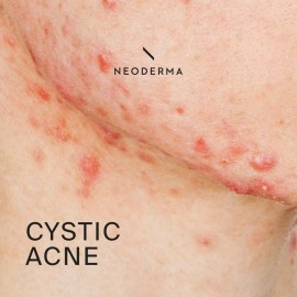 SUPPLEMENTS4ME ACNE CYSTIC REMOVAL   - BACTERIA ACNE  SOLUTION  - Made in USA - GUMMIES