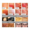 Koi Beauty Professional Dermaroller with 200 Real Micro Needles Home