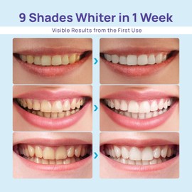 Whitebite Pro Teeth Whitening Kit for Sensitive Teeth – Dual LED Light + 35% Carbamide Peroxide Gel + Remineralizing Gel | Dental-Grade Whitening at Home