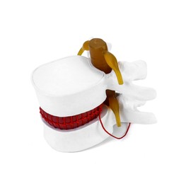 QWORK Anatomical Human Lumbar Vertebrae Degenerative Spine Model - for Teaching & Learning - 1 Pack