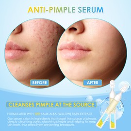 AUSLKA Anti-Pimple Serum Vials, 10% Salix Alba (Willow) Bark Extract Serum, for Oily/Pimple Skin | Oil Control & Eliminate Pimple | Single-Use Vials(1.5ml*30)