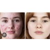 Tratamiento 100% Natural Arrugas Manchas Acne Ojeras Negras