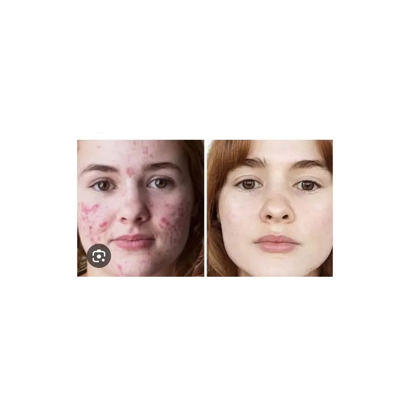 Tratamiento 100% Natural Arrugas Manchas Acne Ojeras Negras