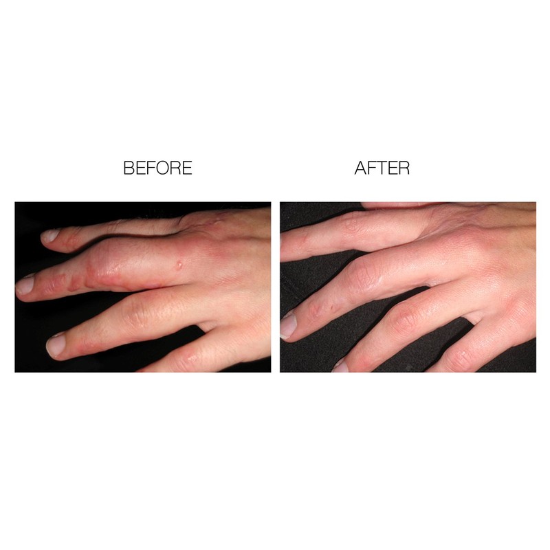 ScarFade Elite Advanced Scar Treatment, Scar Removal, Scar Therapy, Scar