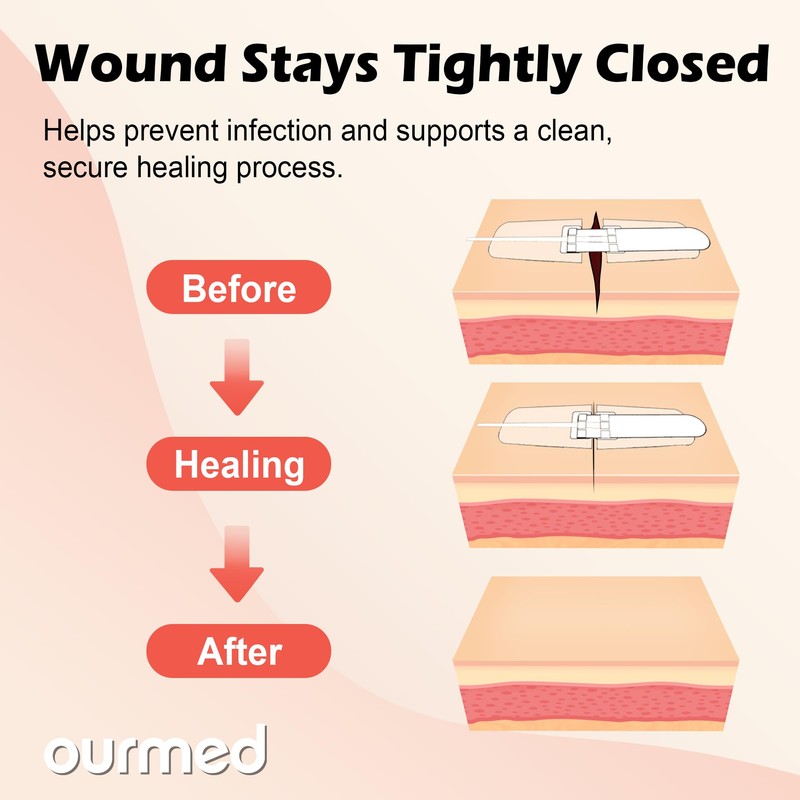 Ourmed Wound Closure Strips(2.4"x 2.8" - 4 Pcs), Butterfly Bandages