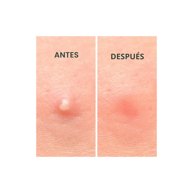 Rael Hydrocolloid Acne Pimple Healing Patch (2 Pack)