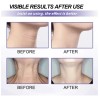 D P Crema De Cuello Eelhoe Retinol Para Arrugas Y