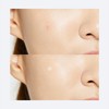 COSRX [COSRX]Acne Pimple Master Patch (3ea X 24 patches)