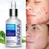 Tratamiento Acne Puntos Negros Manchas Cicatrices Barros