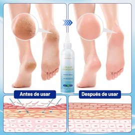 Extra Strength Foot Callus Remover Gel, Exfoliación de Piel Muerta,Foot Callus Remover Gel, Feet Scrubber, Adecuado para Piel Agrietada y Áspera de Lo