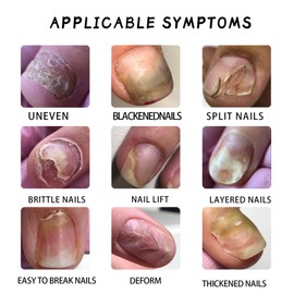 20ml Ginger Nail Growth Serum, Ginger Nail Treatment Nail Support - 7 Days Nail Treatment, Ginger Cuticle Care Oil for Nails