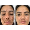 Crema Despigmentante De Paño Melasma Acne