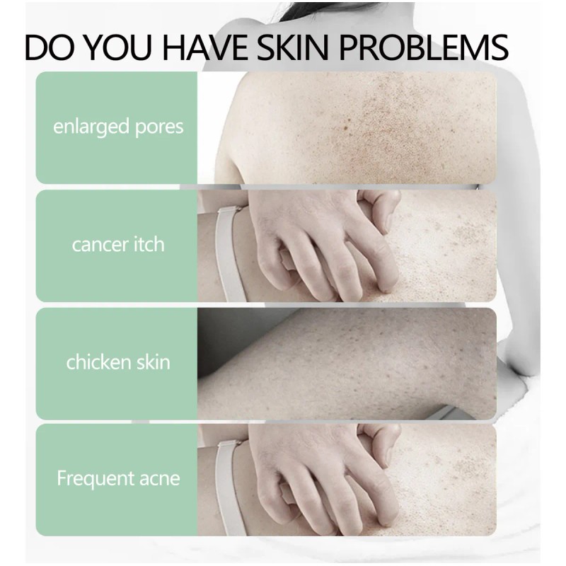 Crema De Pollo Reparadora Corporal Para La Queratosis Que Cu