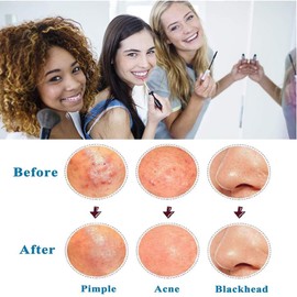 Mitesserentferner-Set, gebogene Pinzette, Mitesserentfernungswerkzeuge, professionelle Pickel, Komedonen-Extraktor, Zit-Druckknopf für Nase, Gesicht, 17 Stück