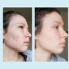 Glycolic Acid 50% Gel Peel - Enhanced with Retinol &