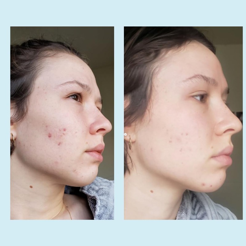 Glycolic Acid 50% Gel Peel - Enhanced with Retinol &