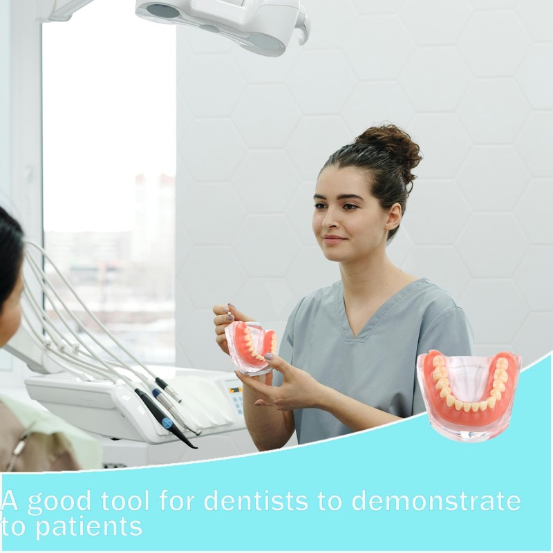 Dental Model Overdenture Transparent Dental Implants Model Detachable Model Lower