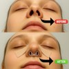 Retenedor de nariz para rinoplastia - Moldeador de nariz de