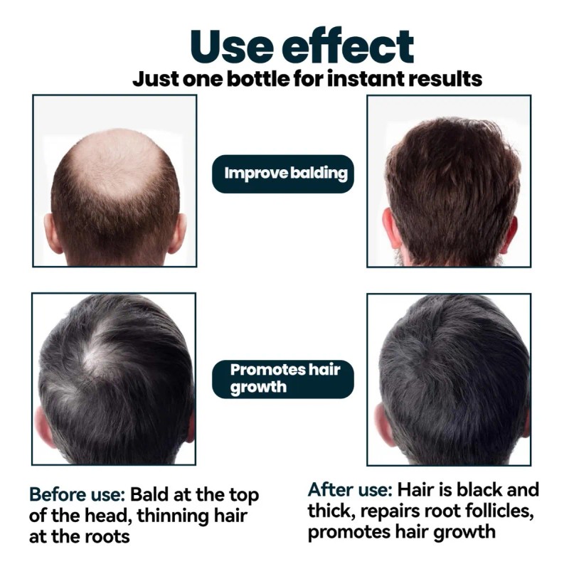 Tratamiento Para Cabello Y Barba Para El Crecimiento Del Cab