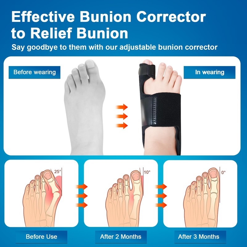 Pomreck Bunion Splints 03