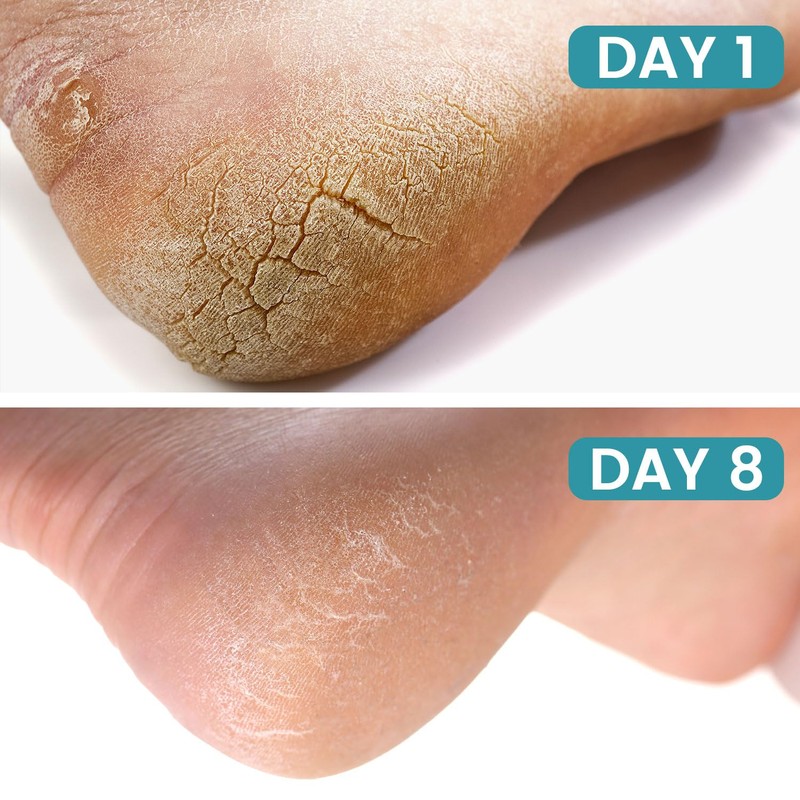 Cracked Foot Cream Roll-On Moisturizer, 1.76floz