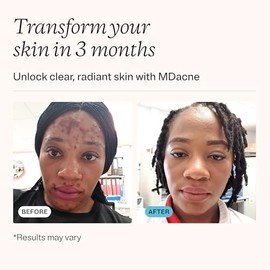 MDacne Kit de acné de retinol de 3 pasos, crema de retinol 0.25%, limpiador de ácido salicílico, humectante de niacinamida, kit a base de plantas para