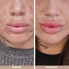 Pimple Pen with Tea Tree Oil and Lemon Myrtle -