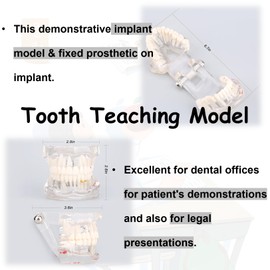 Detachable Dental Model Dental Disease Teaching Study Typodont Demonstration Tooth Model for Adults