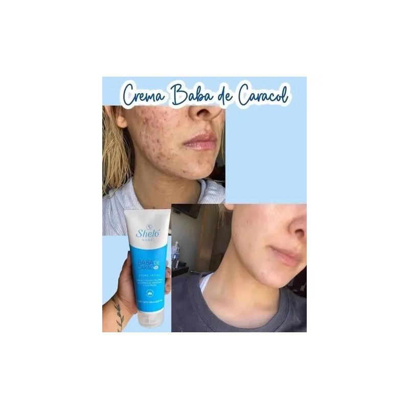 4 Crema Facial Baba De Caracol Manchas Sheló Nabel