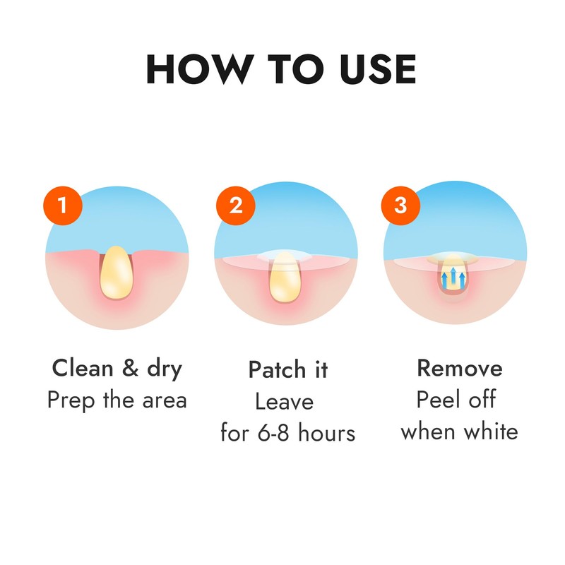Epielle Over-Zit Acne Clear Patches 138 Count, Hydrocolloid Acne Pimple
