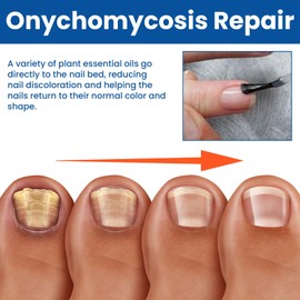 Nail Repair Solution - Quickly & Effectively Solve Toenail Issues. Repairs Damaged, Cracked & Discolored Appearance, Promotes Healthy Growth (30ml)