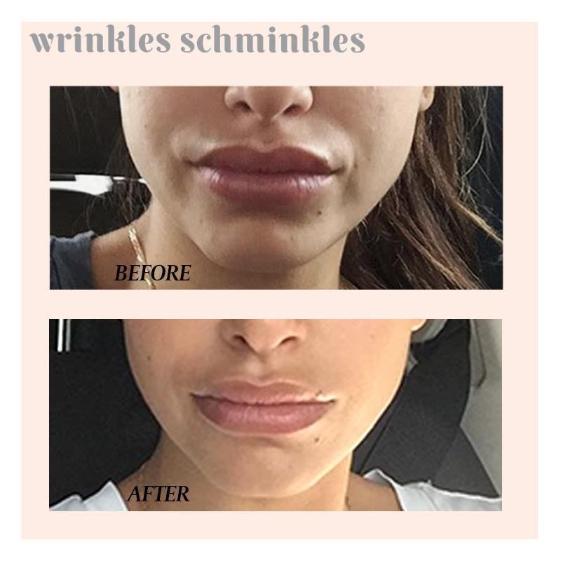 Wrinkles Schminkles Mouth and Lip Wrinkle Patch - 1 Patch