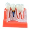 Dental Implant Educational Model, 4X Size, Demonstration Crown and Bridge