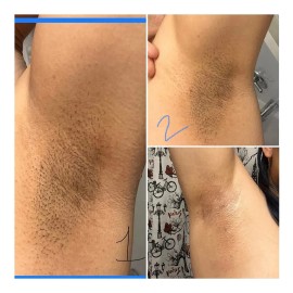 Crema Aclaradora Íntima | Axilas | Codos | Manchas Oscuras