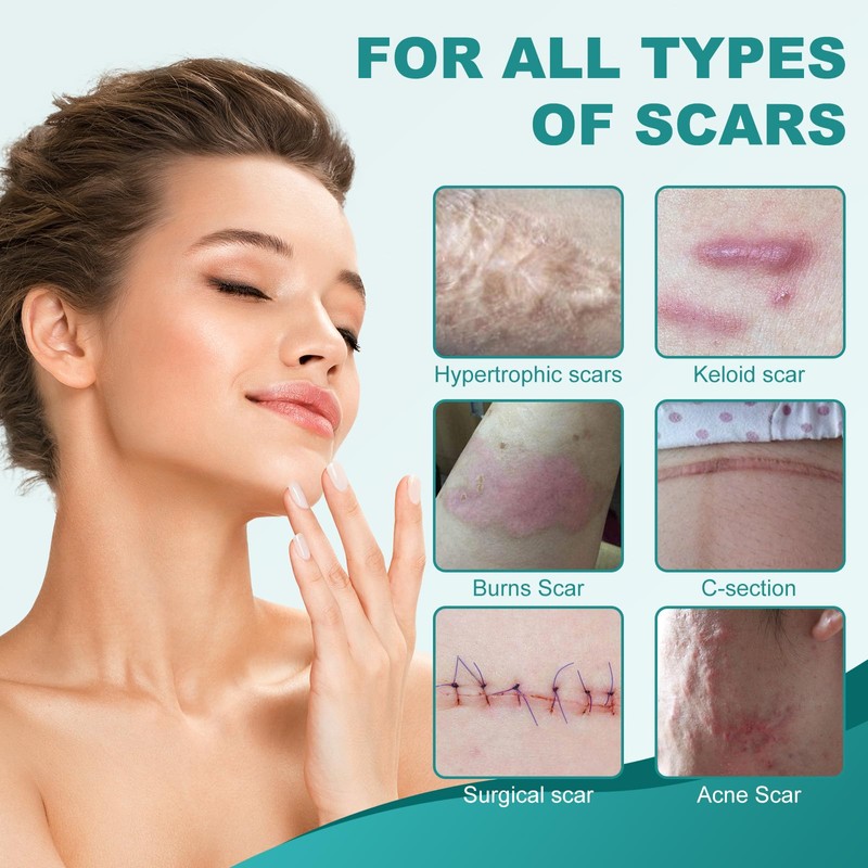 Silicone Scar Sheets, Silicone Scar Tape(1.6"x 158"), Scar Tape for