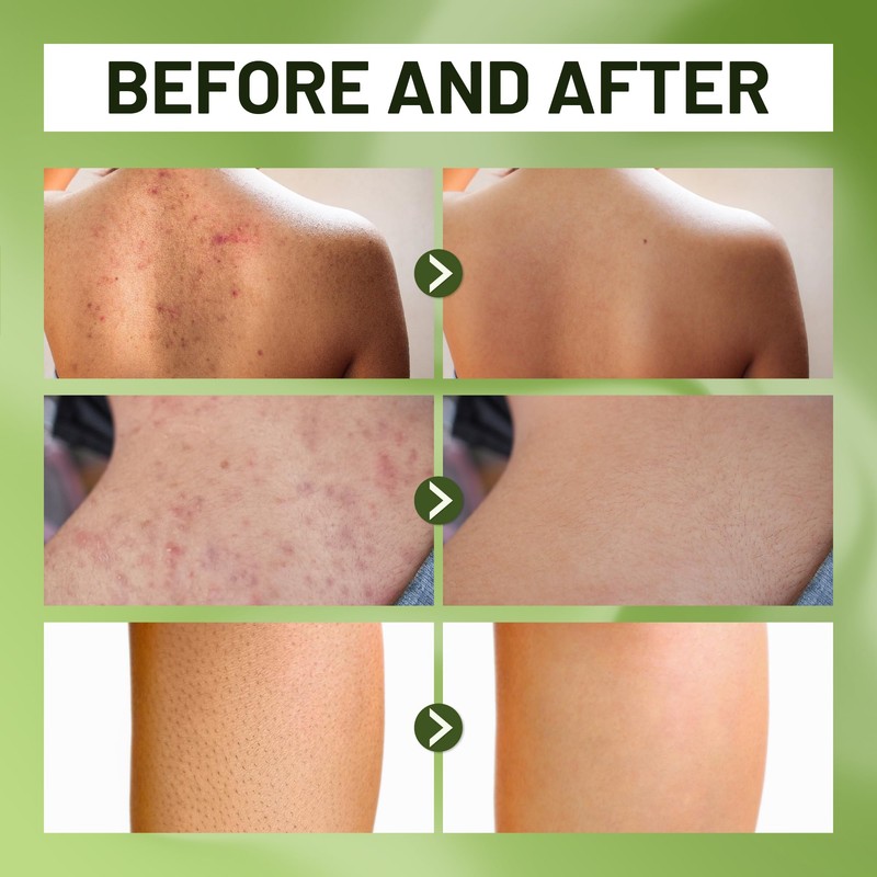 ABERA Folliculitis, BHA Shower Gel, High-Performance Folliculitis Body Wash, Wild
