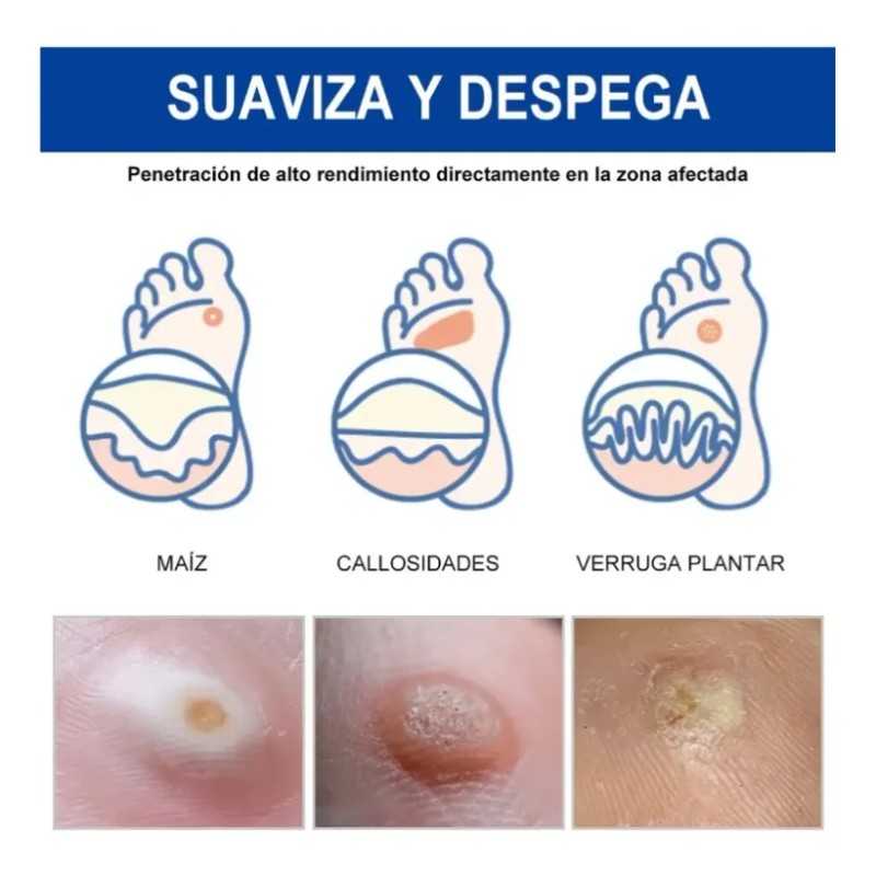 Líquido Mejorador De Verrugas Y Maíz Reva