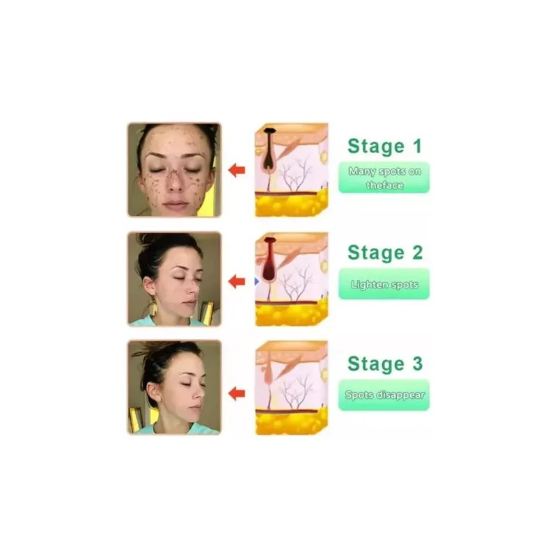 Ern 2 Unidades De Gel Exfoliante Quarxery, Gel Exfoliante