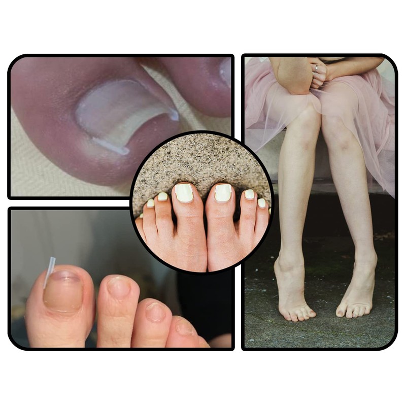 ZoeTekway Ingrown Toenails Set, Includes Ingrown Toenail Lifter Toenail Correction