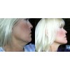 Lifting facial instantáneo, estiramiento de cuello y ojos, ¡MIRA VIDEO!