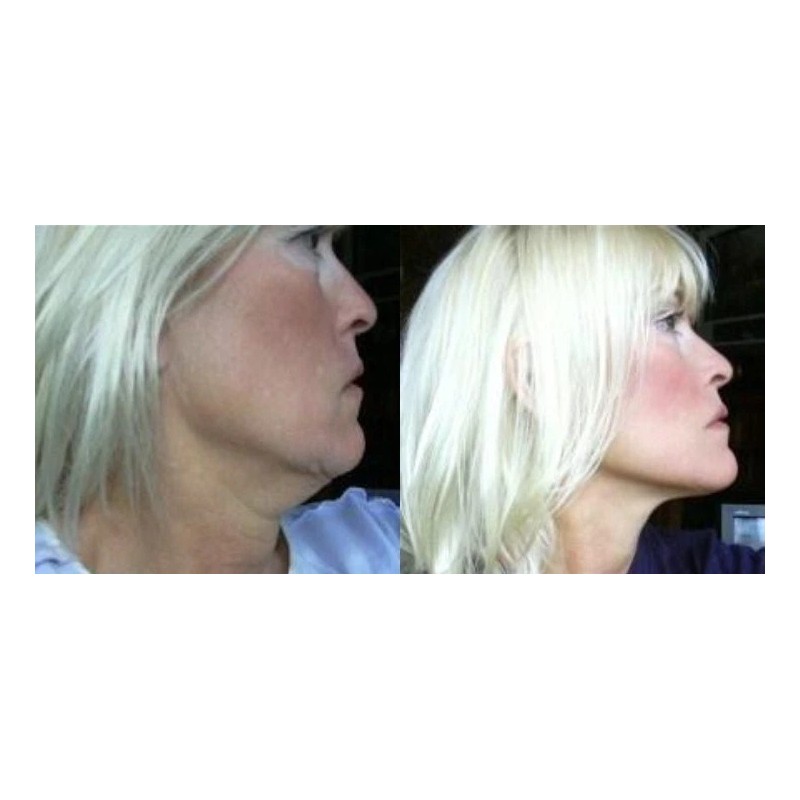 Lifting facial instantáneo, estiramiento de cuello y ojos, ¡MIRA VIDEO!