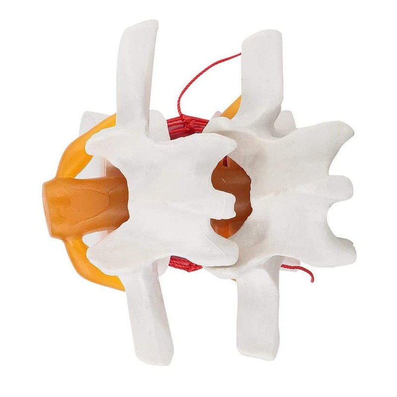 TOBEOME 1:1.5 Human Demonstration Model for Herniated Disc of the